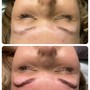 Eyebrow: Microblading