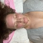 Microdermabrasion