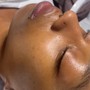 Acne Facial