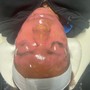 Dermaplane facial