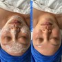 Chemical peel