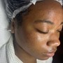 Chemical peel