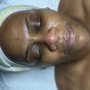 Acne Treatment Facial