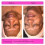 Enzyme Facial