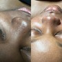 Dermaplaning