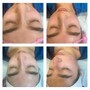 Diamond Microdermabrasion Facial