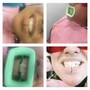 Teeth Whitening