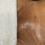 MicroNeedling