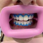 Teeth Whitening