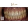 60 min Teeth Whitening