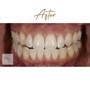 60 min Teeth Whitening