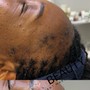 Scalp Micropigmentation