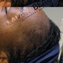 Scalp Micropigmentation