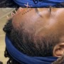 Scalp Micropigmentation