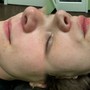 Dermaplane Facial