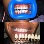 Teeth Whitening (Standard)