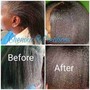 Scalp Treatment