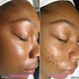 Acne Facial