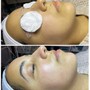 Dermaplaning