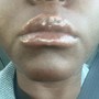 Lip Fillers 1.0ml