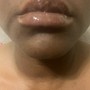 Lip Fillers 1.0ml