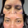 Eyelash Extension Removal