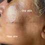 Microdermabrasion