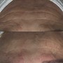 Microdermabrasion