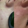 MicroNeedling