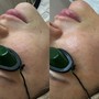 Microdermabrasion