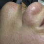 Microdermabrasion