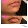 Lip Filler