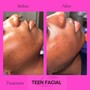 Teen Acne Facial