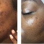 Microdermabrasion