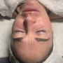 Microdermabrasion