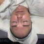 Microdermabrasion