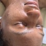 Microdermabrasion