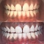 30 Minute Teeth Whitening