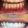 30 Minute Teeth Whitening