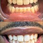 30 Minute Teeth Whitening