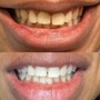 30 Minute Teeth Whitening