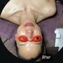 Acne Facial