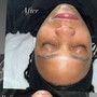 Dermaplaning Facial