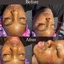 Acne Facial