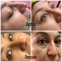 Eyelash Extension Removal