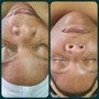 Dermagliding Facial