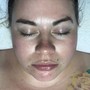 Acne Facial