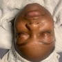 Microdermabrasion