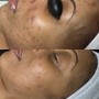 Professional Peptide Peel