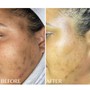 Chemical Peel